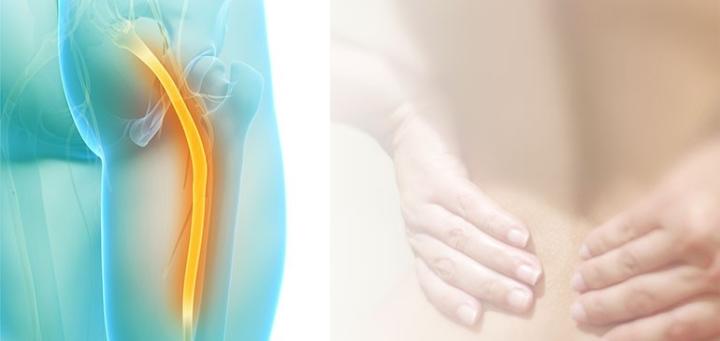 синдром грушевидной мышцы симптомы и лечение