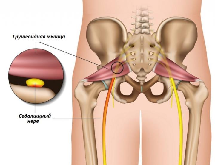 воспаление грушевидной мышцы